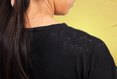 How to Deal with Dandruff in Winter with Ayurvedic Hair Care?